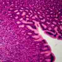 Cancer de lestomac et du duodénum photo Cancer de lestomac et du duodénum cancer