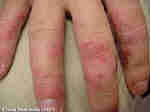 Le Psoriasis : photo Le Psoriasis : dermatologie