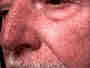 Le Psoriasis : photo Le Psoriasis : dermatologie