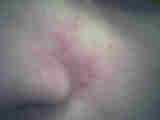 Le Psoriasis : photo Le Psoriasis : dermatologie