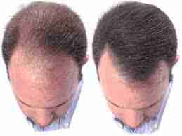 Les meilleurs moyens nutritifs pour les cheveux