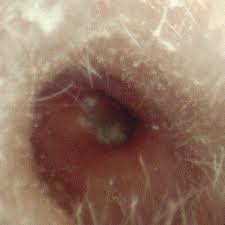 Levomekol du psoriasis les rappels